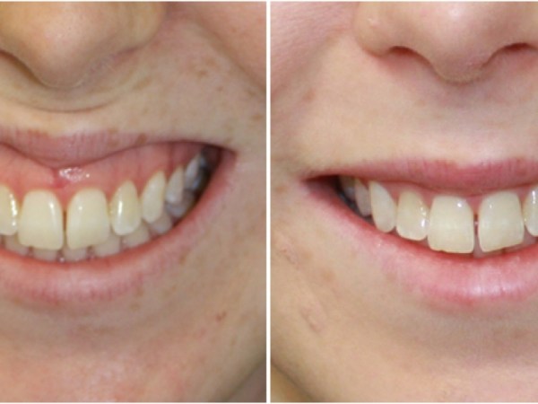 A Way to Smile Confidently: Gummy Smile&nbsp;Surgery